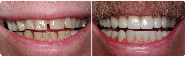 San Diego Porcelain Veneers