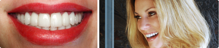 San Diego Porcelain Veneers