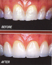 San Diego Porcelain Veneers