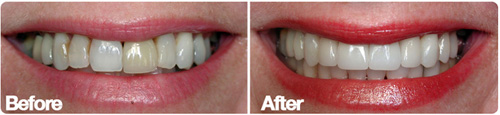 San Diego Porcelain Veneers Color correction