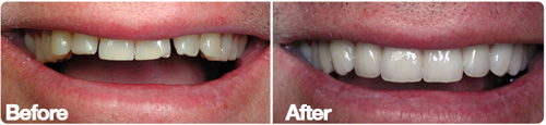 San Diego Porcelain Veneers Space Closure