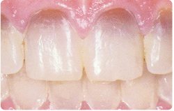 San Diego Porcelain Veneers Tetracycline Stains